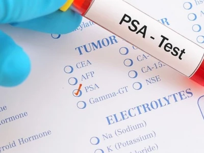 Prostate Cancer Test 03