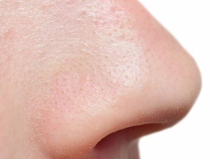 rhinoplasty