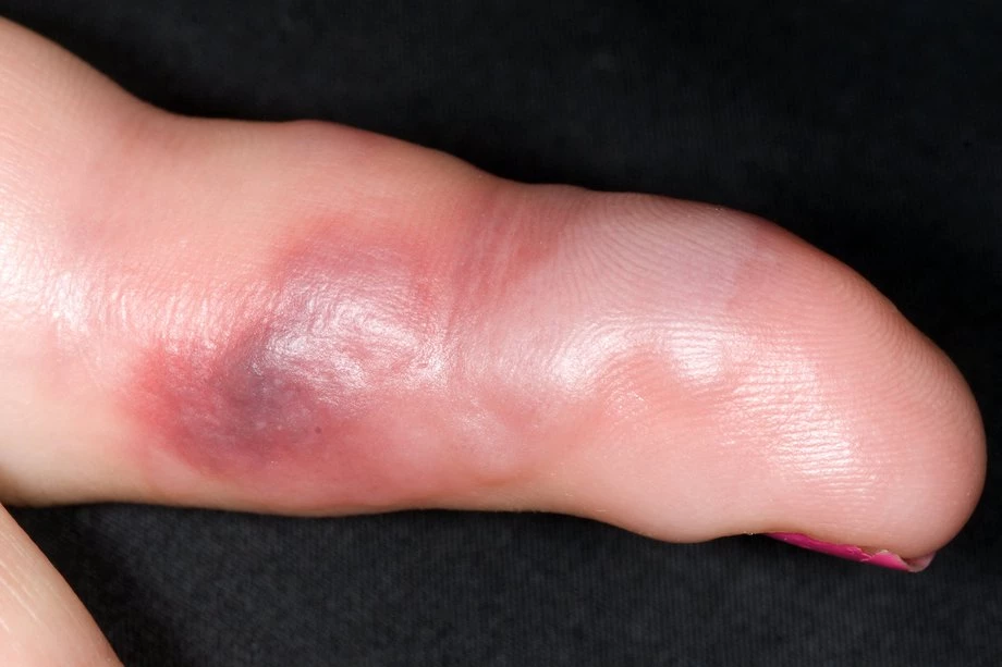 wasp sting